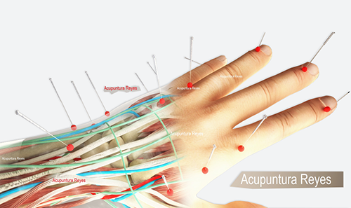 Acupuntura